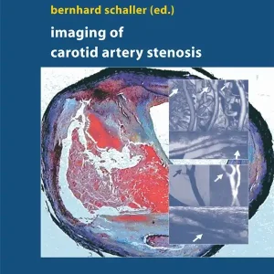 Bästa pris Imaging of Carotid Artery Stenosis | 1:a upplagan