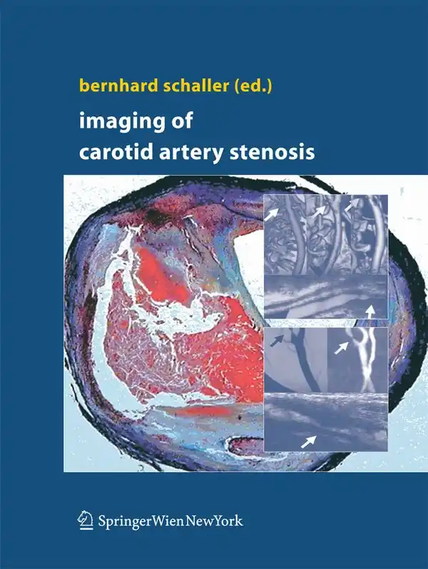 Bästa pris Imaging of Carotid Artery Stenosis | 1:a upplagan