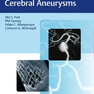 Flow Diversion of Cerebral Aneurysms | 0:e upplagan Expressleverans